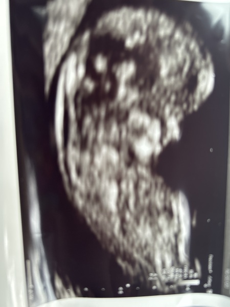 Based on nub theory, any guesses on baby's sex for fun?