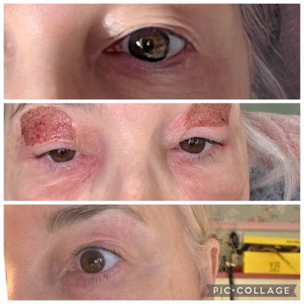 My wrinkly upper eyelids are bothering me - I know this is both unreasonable and futille but nonetheless
