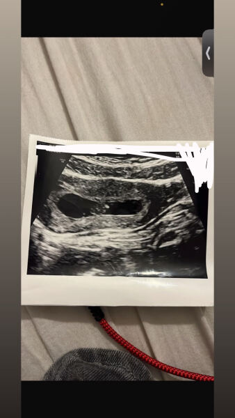 Possible twin pregnancy