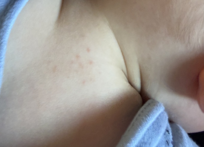 Does this look like breakthrough chickenpox while on aciclovir?