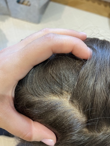 What could this patch in my toddler’s hair be?