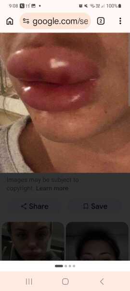 To ask if you had terrible embarrassing lip filler swelling