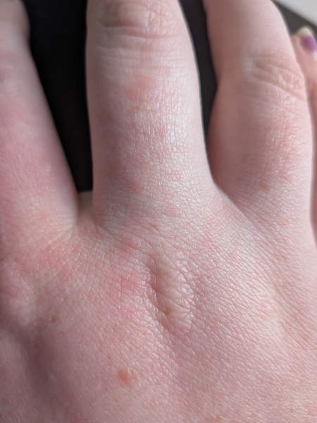 Any idea what this is on my hand? (Photo)