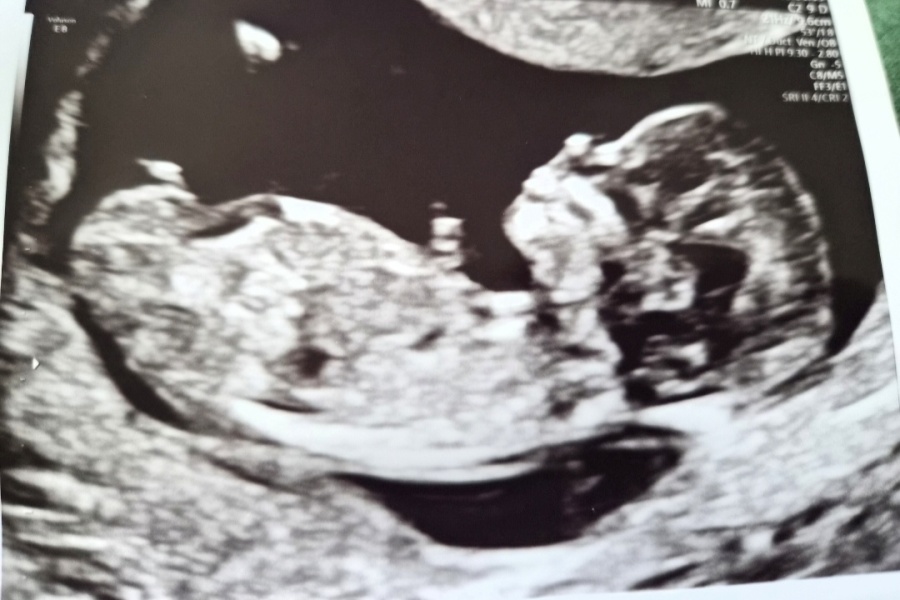 12 weeks 5 days pregnant, any nub theory guesses?