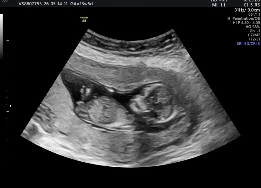 Pregnant with my third, any guesses on baby's sex tomorrow?