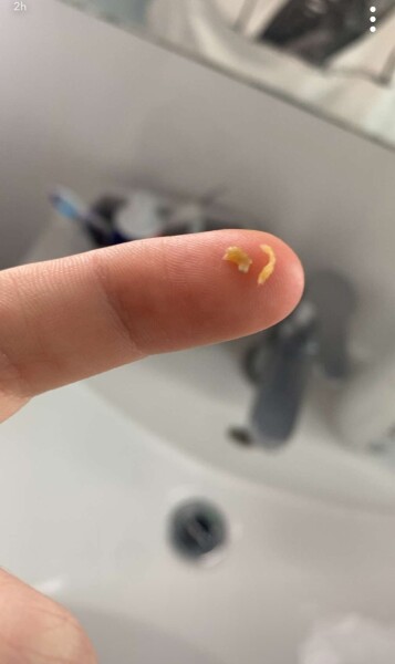Help with DS's blackheads