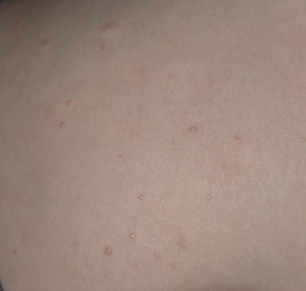 What could these spots on my 5yo DS be?