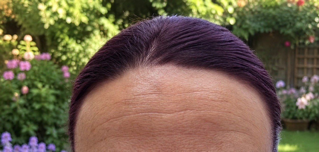 AIBU to consider Botox for forehead lines at 40?