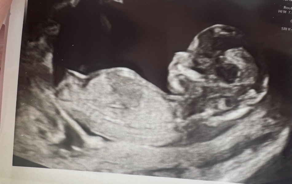 13 week scan nub theory?