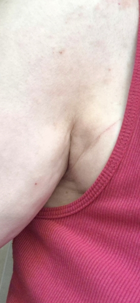 Extremely worried about this boob dimple