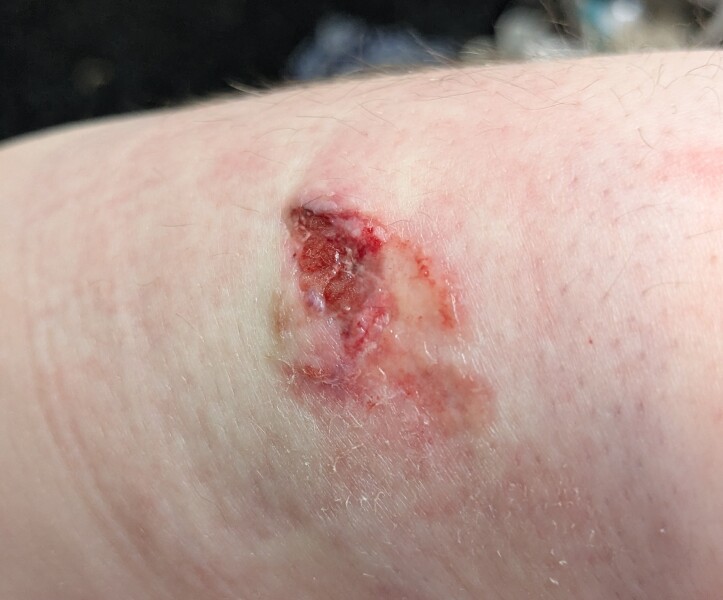 AIBU to ask if this arm wound needs attention? Contains a bloody pic of said wound