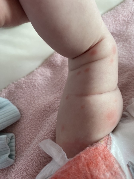 AIBU to worry about rash spreading after 12 week jabs?