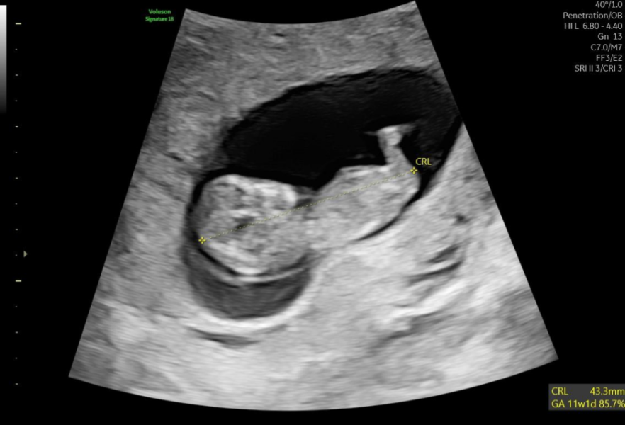 Any sonographers on here?