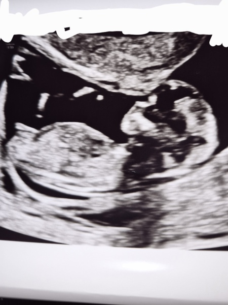Boy or girl guesses?