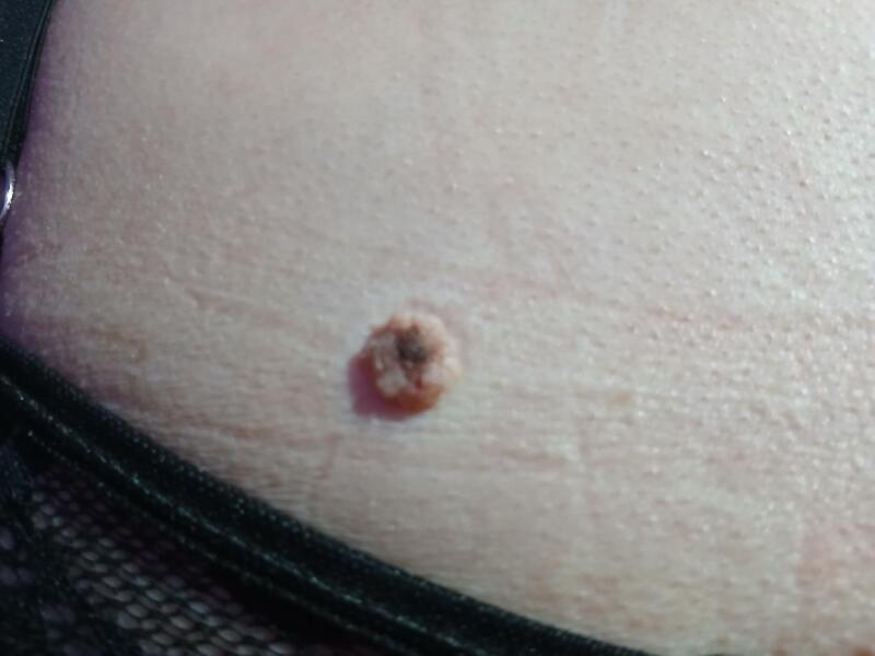 Should i be concerned about my mole?