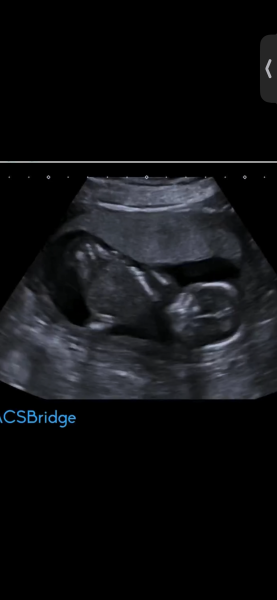 Still nauseous at 18 weeks and wondering about nub theory