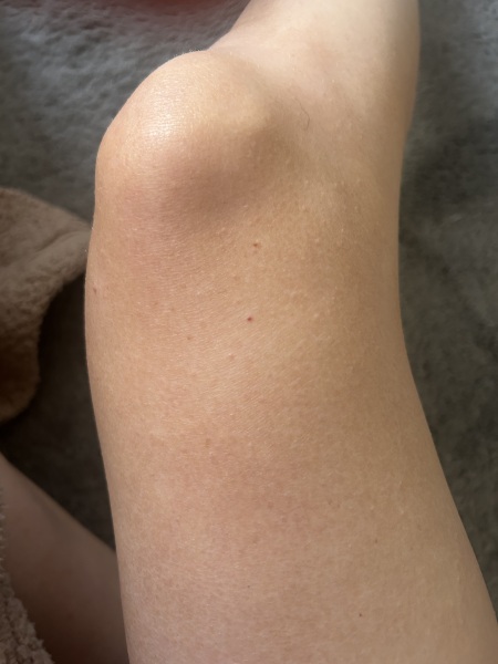 Red pinprick spot on skin that does not fade, any ideas?