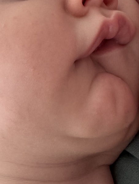 Breastfeeding newborn with shallow latch and lower lip tucking in
