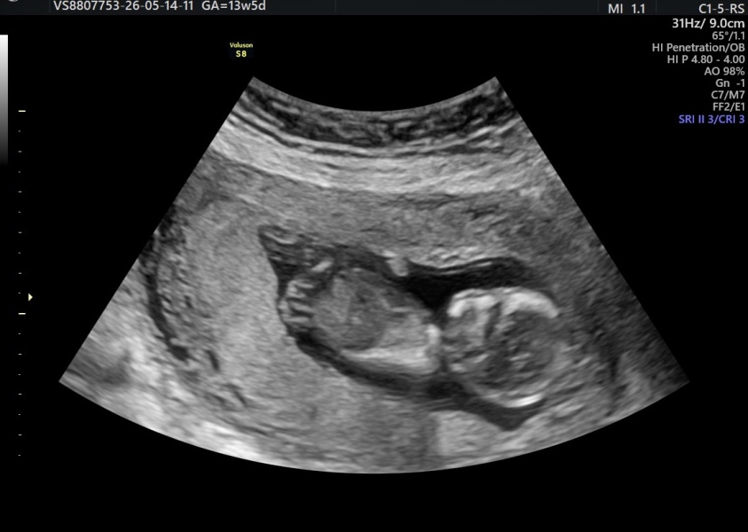 Pregnant with my third, any guesses on baby's sex tomorrow?