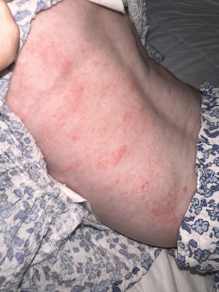 Going mad now, what could be causing this awful rash on 6 month old. With photo