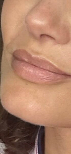 To ask if you had terrible embarrassing lip filler swelling