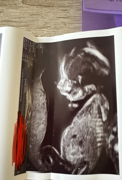 20 weeks boy or girl?!