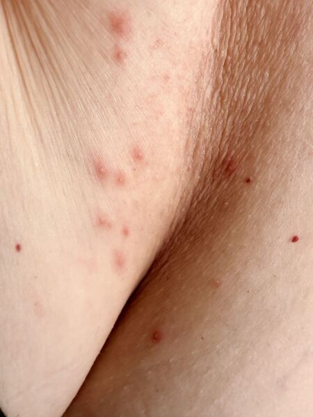 Can anyone identify my friend’s rash?