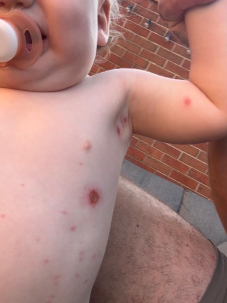 Impetigo or something else? Very worried