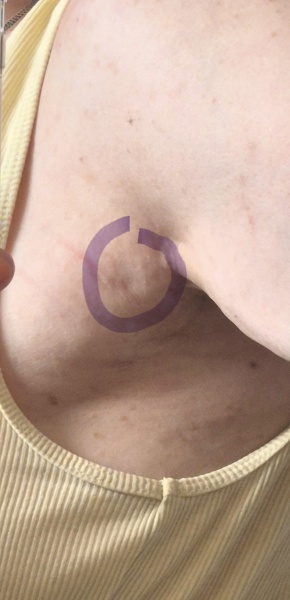 Extremely worried about this boob dimple