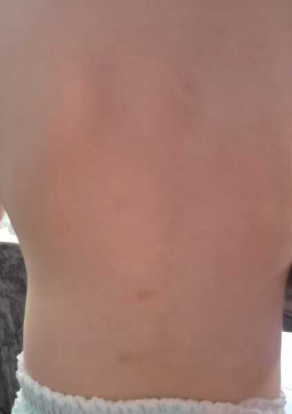 Normal bruising?
