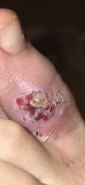 Infected stitches