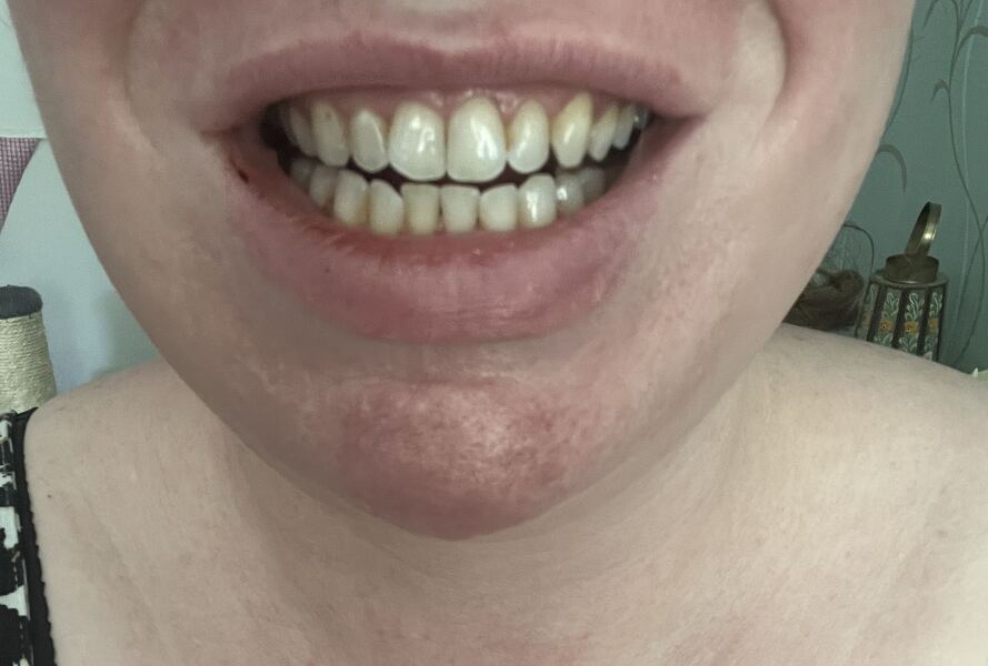 Tooth implant/bridge or nothing?