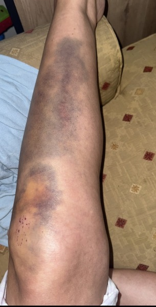 Advice to help the bruising go down pics included