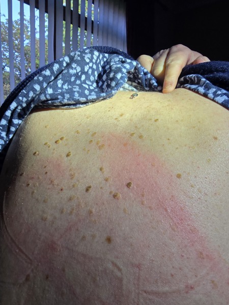 Could these be seborrhoeic keratoses or flat warts on my back?