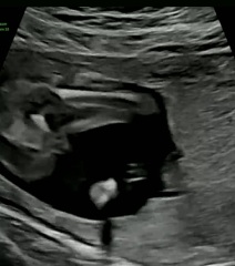 17 week potty shots. Confused. Please help!