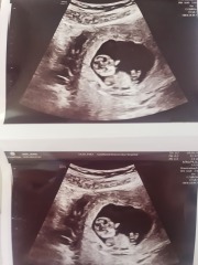 Boy or girl guesses for my pregnancy