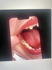 Dentist… Molar incisor hypomineralisation