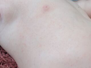 Could this rash on my one year old be heat rash?