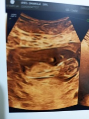 Can anyone apply nub theory to this pregnancy scan?