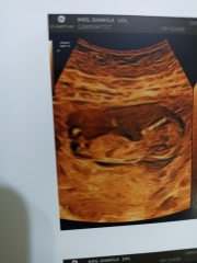 Can anyone apply nub theory to this pregnancy scan?