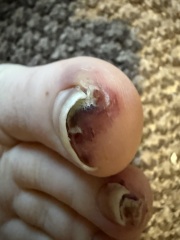 Weird rash on my toes & other symptoms anyone else had this?