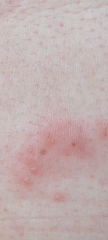 Does this rash look like shingles or just an insect bite?