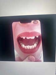 Dentist… Molar incisor hypomineralisation