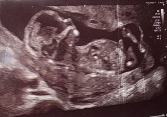 Going down a rabbit hole with nub theory (yes I know I am crazy) - Is this definitely a boy!