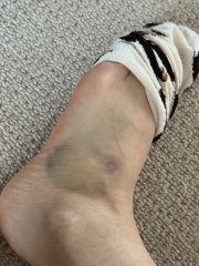 Lump and pain after ridiculous foot injury - need X-ray opinions!