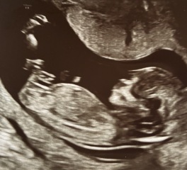 Can anyone please help guess our baby’s sex from a 13 week scan?