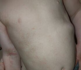 Allergy test for 2 yr old?