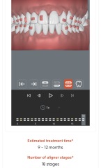 Unsure on Invisalign results