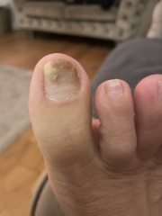 Black toenails