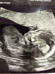 Cleft lip